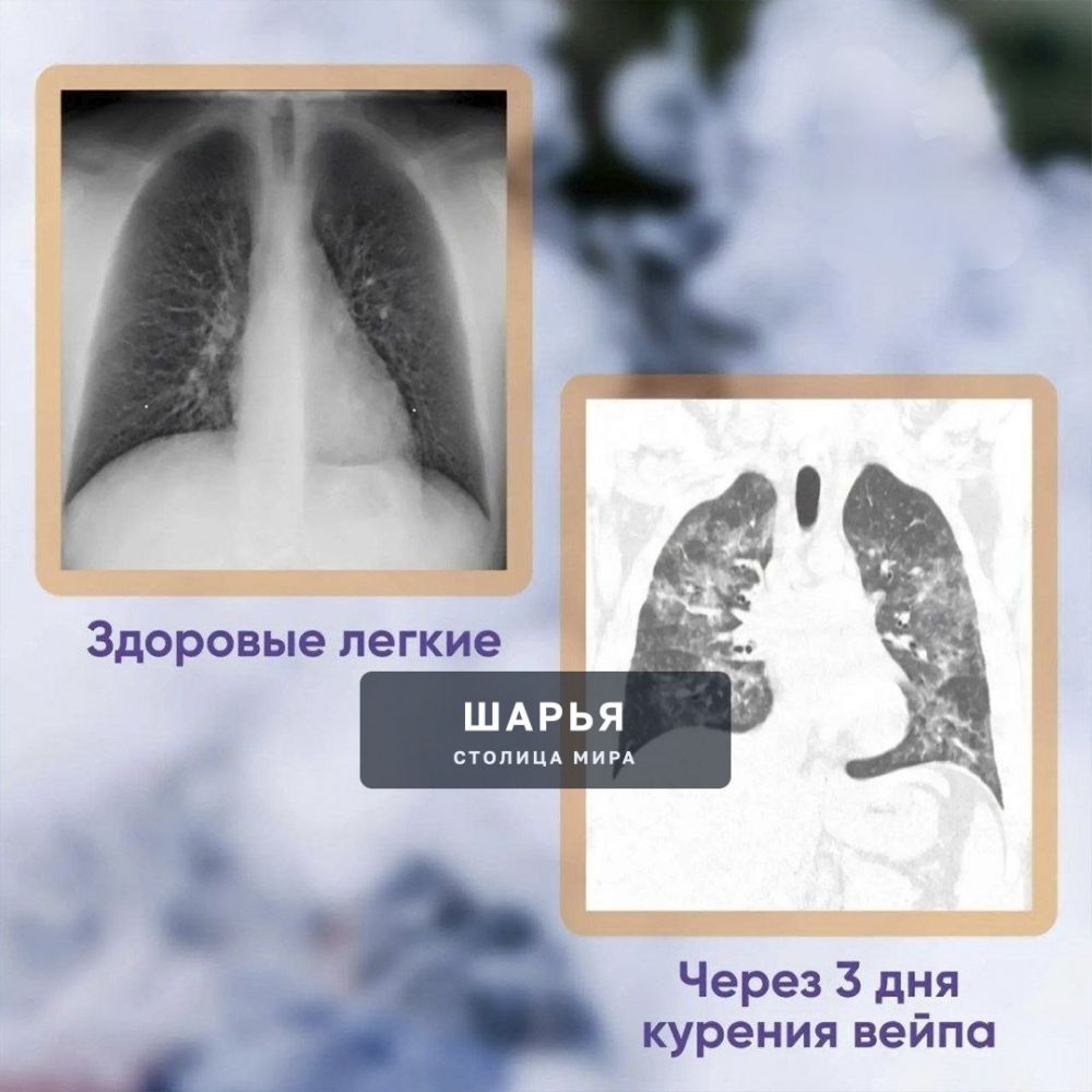 ‼ 19-летний парень РАЗУЧИЛСЯ ДЫШАТЬ из-за вейпов — у него выявили тяжёлое поражение лёгких… — Шарья