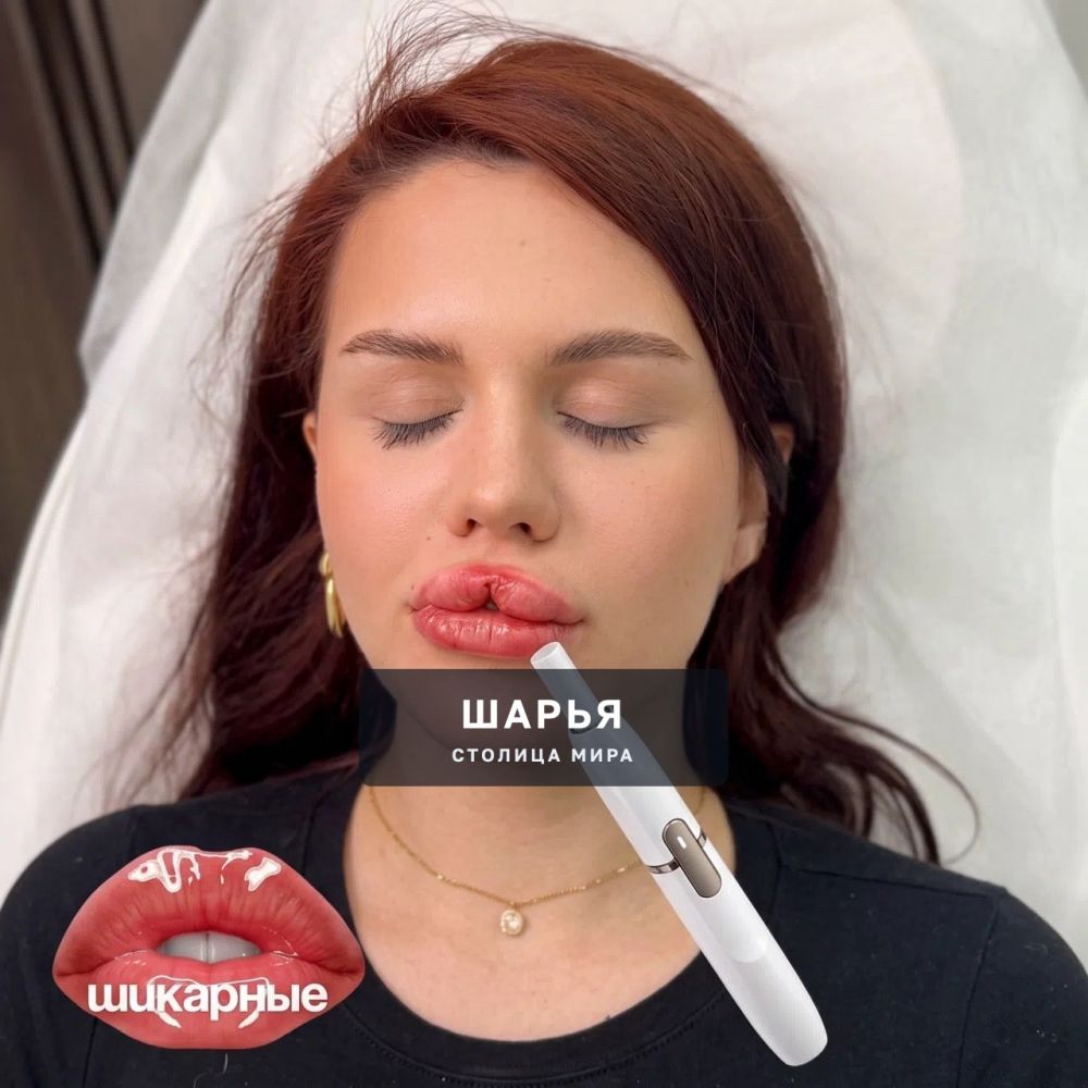 ГУБЫ «ПОД АЙКОС» начали делать косметологи россиянкам — клиентка попросила мастера сделать… — Шарья — фото 1