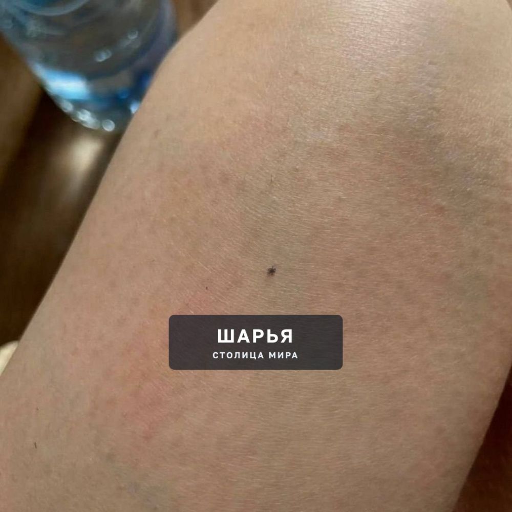 ‼ НАНОКЛЕЩИ ПОЯВИЛИСЬ В РОССИИ — микрокровопийцы, которые опаснее взрослых особей, уже атакуют… — Шарья — фото 3